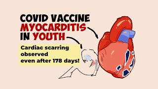 COVID Vaccine Myocarditis in Youth: How Serious Is It? (New Study Results)