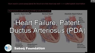 Heart Failure, PDA