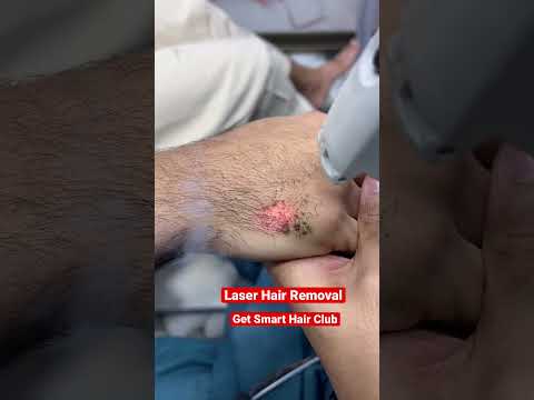 laser hair removal
