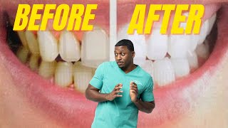 Four EASY Steps To Removing Yellow Tartar ASAP!