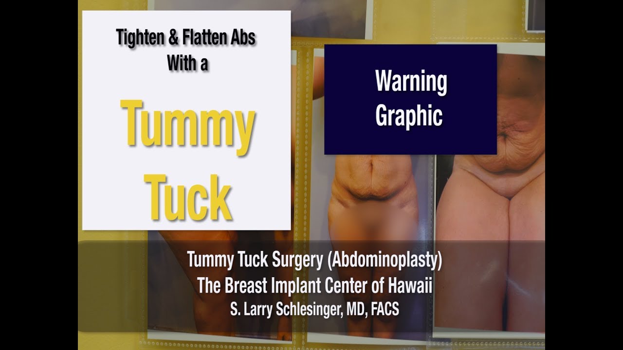 Flatten Tummy and Tighten Abdominal Muscles w/Tummy Tuck - Graphic Plastic Surgery - Breast Implant Center of Hawaii