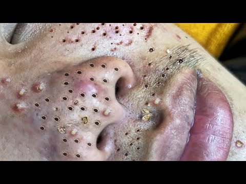 Blackhead Removal With Sac Dep Spa @100074149