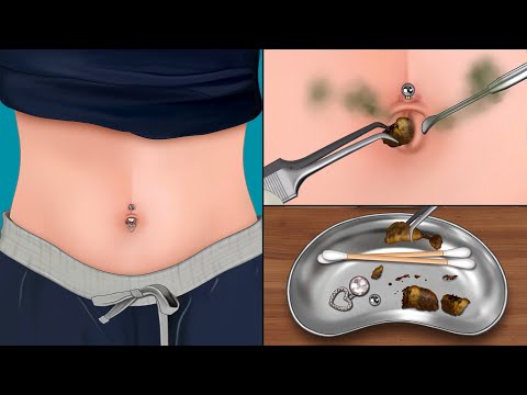 ASMR 시원함 주의! 몇 년 동안 묵은 거대한 배꼽 돌 제거하기 | 배꼽 청소 | 피어싱 제거 | Remove Huge Navel Stone