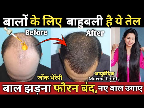 बालों का झड़ना रोकें,गंजेपन से छुटकारा पाएं सिर्फ 90 दिन में, Stop Hair Fall & Regrow Hair Naturally