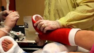 Reapplying foot casts after surgery. Part 4 of 4
