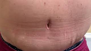 Tummy Tuck Before And After- 10 Lbs Removed After Gastric Sleeve!