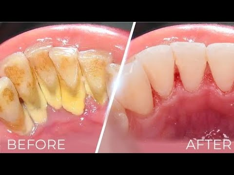 ازالة جير الاسنان removal dental calculus #dr_abdullah_sultan_dentist #ازالة_جير_الاسنان