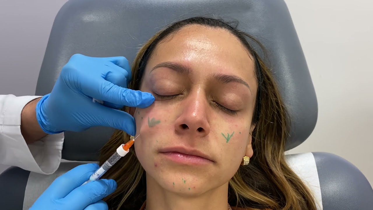 Woman with markings for cosmetic procedure preparation.