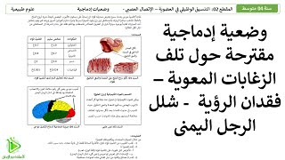 وضعية إدماجية مقترحة للشهادة BEM -  تاكل الزغابات المعوية بروح الملح وفقدان الرؤية وشلل الرجل اليمنى