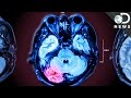 Understanding Chronic Traumatic Encephalopathy (CTE)