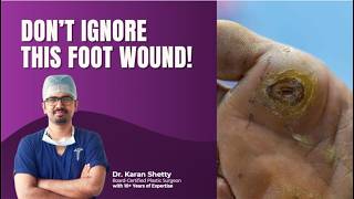Diabetic Foot & Wound Care: Common Mistakes Explained by Dr. Karan Shetty | Plastic Surgeon BLR