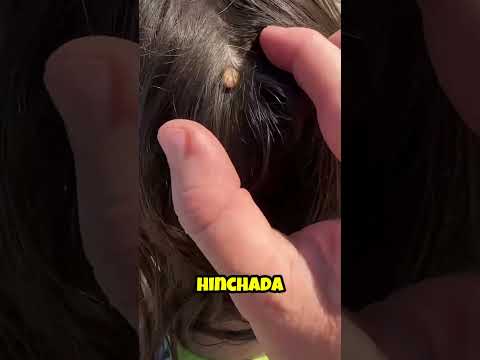 esta MADRE le SACÓ una GARRAPATA ENORME a su HIJA