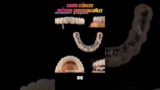 Casos clínicos #protesisdentogingival #4digitallab #nelsoncalderod #protesisdental #casosclínicos