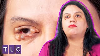Yumrular Yüzünden Evsiz Kaldım | Doktor Çıbanım - Dr. Pimple Popper