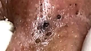 Blackheads & Whiteheads Satisfying Removal Acne and Pimple @0790