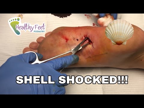 WHAT WAS IN THE FOOT!!?!?!