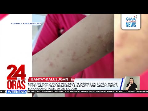 Kaso ng hand, foot and mouth disease sa bansa, halos triple ang itinaas kumpara... | 24 Oras Weekend