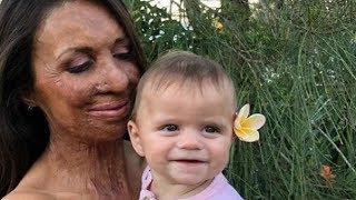 Turia Pitt has welcomed a baby boy