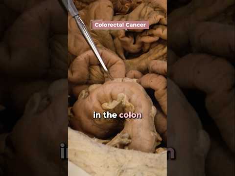 How These Bodies Died From Cancer…