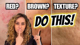 Skincare vs. Laser Treatments for Redness, Dark Spots, & Texture | From a Dermatologist