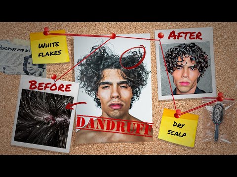 How I got rid of a Dry Scalp FAST!