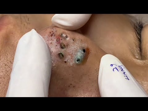 Big Cystic Acne Blackheads Extraction Blackheads & Milia, Whiteheads Removal Pimple Popping # 432