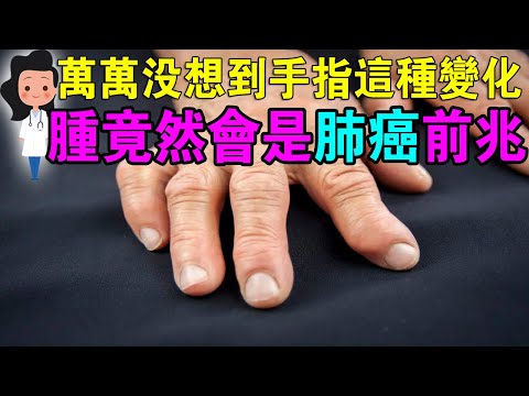 身體若有癌症，手會成為“傳令兵”，這4種手部表現，可能是癌症前兆手部出現4種變化，可能是癌症訊號！ 千萬不要拖！「萬萬沒想到，手指腫竟然會是肺癌！