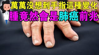 身體若有癌症，手會成為“傳令兵”，這4種手部表現，可能是癌症前兆手部出現4種變化，可能是癌症訊號！ 千萬不要拖！「萬萬沒想到，手指腫竟然會是肺癌！