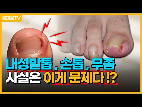 내성발톱과, 손톱, 그리고 무좀 ' 이것 ' 만 해결되면 끝!