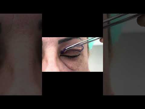 Ce părere aveți despre operația de Blefaroplastie? #blefaroplastie #operatie #chirurgplastician
