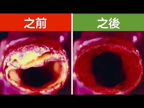 清血管的最好食物,預防血管硬化,柏格醫生 Dr Berg