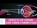 Vision Defects and Corrections