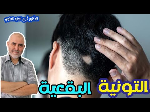 التونية البقعية نتيجة التوتر   -   الدكتور كريم العابد العلوي  -