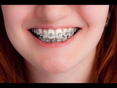 рдмрд┐рдирд╛ рддрд╛рд░ рд▓рдЧрд╛рдпреЗ рдЯреЗрдврд╝реЗ рдореЗрдврд╝реЗ рджрд╛рдВрдд рд╕реАрдзреЗ рдХрд░рдиреЗ рдХреЗ рдЕрд╛рд╕рд╛рди рдШрд░реЗрд▓реВ рдЙрдкрд╛рдп