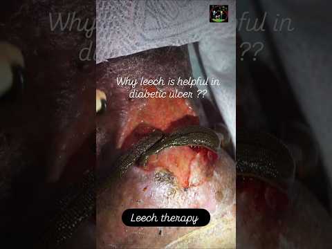Leech Therapy for Diabetic Ulcer 🩸 | Fast Healing Ayurveda Treatment #Leech therapy #diabeticulcer