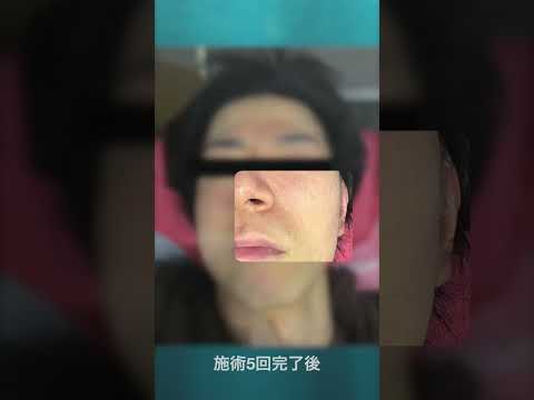 【脱毛・フェイシャル】 当店イチオシの水光ピールのビフォーアフターになります。ぜひ効果を動画で感じてください!#shorts #makeupvideo #beautyface #skincare
