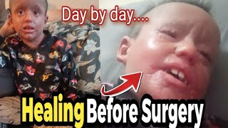 Healing Before Surgery|Usman recovery journey|