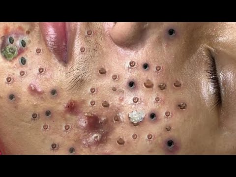 Blackhead Removal With Sac Dep Spa @100074206