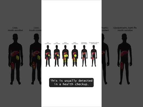 Google Gemini can predict Insulin Resistance