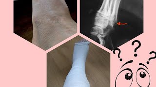Broken leg Slc plaster leg cast 