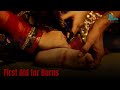 Burn Treatment and First Aid