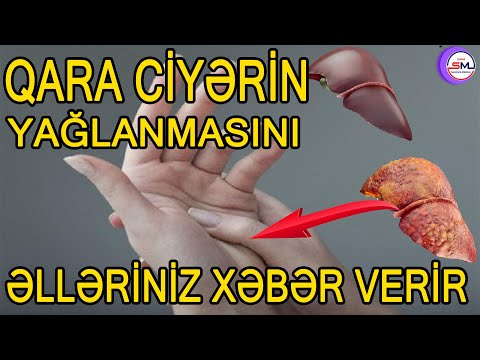 Əlləriniz sizə qaraciyərinizin sağlamlığından xəbər verir