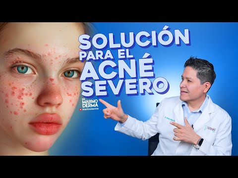 SOLUCIÓN PARA EL ACNÉ SEVERO || Consejos de un dermatólogo