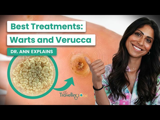 Welcome to The Travelling Doc's YouTube channel – your trusted companion on the journey to better health and well-being! Are you tired of dealing with warts and veruccas? 
In this video, we break down the different types of warts and veruccas and explain why they occur. We then dive into the various removal methods, including freezing, burning, and surgical removal, and discuss their pros and cons. You'll also learn about natural remedies such as apple cider vinegar and tea tree oil, and if they can effectively get rid of these pesky growths. 


✅ FOLLOW ME and Subscribe now, and let's get started on your path to well-being! 💪🏥
👉 Bio: https://linkin.bio/the-travellingdoc  
👉 Website: https://TheTravellingDoc.com/ 
👉 Instagram: https://www.instagram.com/the.travellingdoc/  
👉 Twitter: https://twitter.com/TravellingDocUK
👉 LinkedIn: https://www.linkedin.com/company/the-travelling-doc
======================================

🌟 Embark on a voyage of discovery with me, Dr. Ann, as your dedicated physician. I'm here to empower you with the knowledge and insights you need to lead a healthier, happier life.

📚 From expert doctor's advice to practical tips, I'm committed to providing you with the guidance you deserve.

🩺 Your well-being is my priority, and together, we'll navigate the path to a healthier you. So, hit that "Subscribe" button and join our ever-growing community of health-conscious individuals.

🌐 For even more valuable resources, visit my website at https://TheTravellingDoc.com/. Your health journey begins here, and I'm thrilled to be your trusted guide.
======================================

✅ Other Videos You Might Be Interested In Watching:

👉 Urine Infections Symptoms, Treatment, Cystitis, Doctor explains
https://www.youtube.com/watch?v=BG4Q0zs5nSs

👉 GENITAL WARTS - Doctor Explains
https://www.youtube.com/watch?v=Bh7XUq0HORE

👉 HPV Vaccine - HPV Myths + HPV Facts + HPV virus
https://www.youtube.com/watch?v=ig7q1H474Y4

👉 Welcome to my page
https://www.youtube.com/watch?v=TsFJLneyvwU
 
===============================

✅ Welcome to TheTravellingDoc.

Dr. Nainan is a family medicine doctor with over 10 years of experience. She obtained her MBBS from Keele University and holds diplomas from The Faculty of Sexual and Reproductive Medicine. Dr. Nainan has also received further training on tropical diseases with Doctors Without Borders. 

She has worked at various Trusts in the UK and has international medical experience in South Africa, India, and Bangalore. Her approach to well-being is holistic, addressing physical, mental, and spiritual health to develop a comprehensive treatment plan. 

Dr. Nainan focuses on urgent care for acutely unwell patients and also provides telemedicine services for chronic and new health concerns, utilizing health technology to ensure the accurate and safe medical information is accessible.

🔔 Don't forget Please Subscribe to My Channel to get more health-related Videos: https://www.youtube.com/@TheTravellingDoc

======================================

#urineinfection #menshealth #symptoms #treatment #medicaladvice #prevention

Disclaimer: The Video Content on this channel is for educational purposes and not intended to be a substitute for professional medical advice, diagnosis, or treatment. Always get advice from your doctor if you are worried or have symptoms.

Copyright Notice: This video and our YouTube channel contain copyrighted music and images. Any public, media, and other business usage are subject to a business license. Unauthorised usage and publications are prohibited. 

© TheTravellingDoc