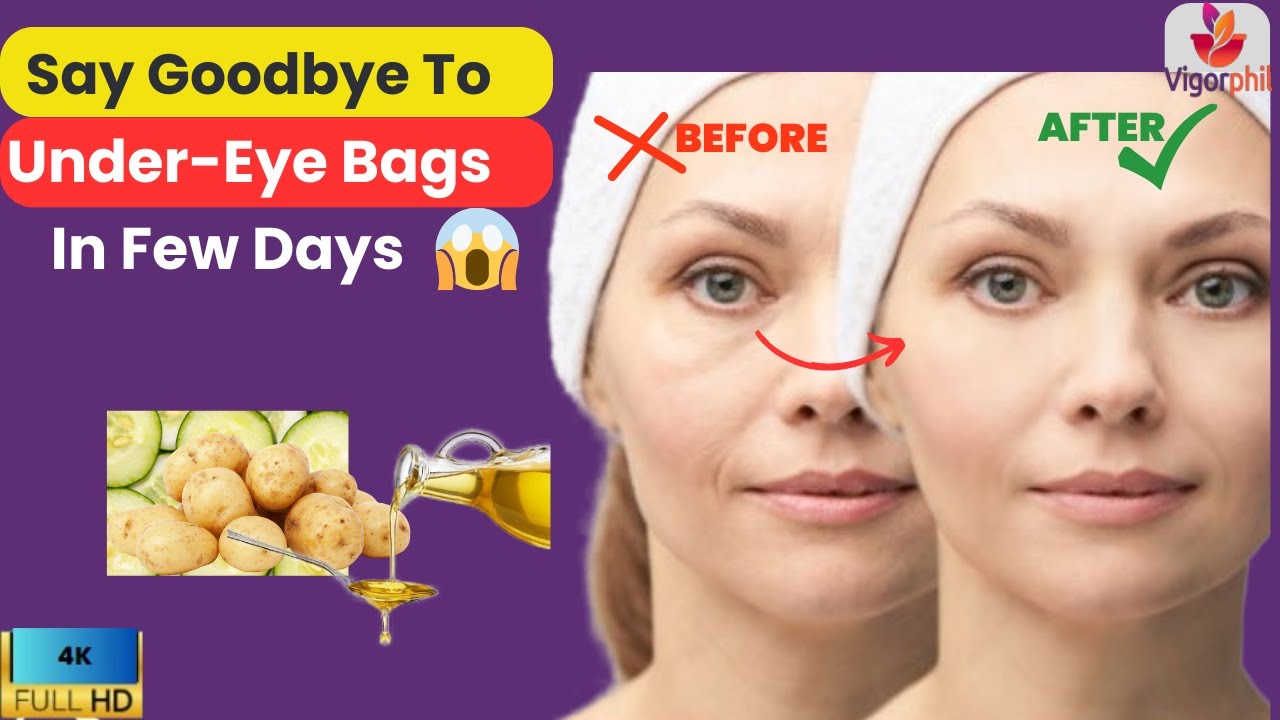 In this comprehensive 30-minute video, we'll delve into the root causes of under-eye bags and explore a range of natural remedies to help you regain a refreshed and youthful appearance. Join us on this journey to healthier, more vibrant skin
==========
FREE PRODUCTS:
Organic coconut oil:
https://vigorphil.com/recommends/coconutoil/

TrulyFree 300 Laundry Loads
https://vigorphil.com/recommends/trulyfree-300-laundry-loads/
==========

OUR RECOMMENDS
Get All You Organic And Vegan Products Here
https://vigorphil.com/recommends/pure-organic-products/

ANNA'S Wild Yam Cream (Her) Menstrual & Menopausal Symptoms
https://vigorphil.com/recommends/annas-wild-yam/

Organic Certified Castor Oil 
https://vigorphil.com/recommends/castor-oil/

Shrink Prostate Of Any Size
https://vigorphil.com/recommends/shrink-prostate-naturally/

Get Paid $500 For Losing Fat
https://vigorphil.com/recommends/get-pay-for-losing-fat/

VisiSharp for Strong Eyes & Vision:
https://vigorphil.com/recommends/visisharp/

Regrow a Head Full of Hair:
https://vigorphil.com/recommends/hair-loss/

Joint Pain and Inflammation Product:
https://vigorphil.com/recommends/product-for-joint-pain-and-inflammation/

My husband called me sexy again, I’m down 4 pounds in the last week:
https://vigorphil.com/recommends/natural-probiotics/

Get Immune to Mental Decline. 
https://vigorphil.com/recommends/memo-surge/
==========

SHOP NOW:

Feel to visit on online store for your Health and ORGANIC Products at https://vigorphil.com/store/

Feel free to use our affiliate link to GET YOUR HEALTH stuff and other products (at no extra cost to you!): 

==========

SUBSCRIBE:

Start taking charge of your health and happiness: https://www.youtube.com/channel/UCG0BxEUXm0dK2UkzA85I9fg?sub_confirmation=1


==========

MY BLOG: 

Learn MORE for FREE: https://vigorphil.com/blog

==========

LET'S CONNECT:

FACEBOOK: https://www.facebook.com/vigorphil
TWITTER: https://www.twitter.com/vigorphil 
INSTAGRAM: https://www.instagram.com/vigorphil 
LINKEDIN: https://www.linkedin.com/company/vigorphil/
PINTEREST:
https://www.pinterest.com/vigorphil/
TITOK:
tiktok.com/@vigorphil
WHATSAPP:
https://wa.me/message/VKAMW54IR4R2E1

==========

DISCLOSURE: 

This video and description may contain affiliate links, which means that if you click on one of the product links, I’ll receive a small commission (and at no extra cost for you!). This helps support the channel and allows me to continue to make videos like this. Thank you for your support! 

==========

DISCLAIMER: 

The information I supply here is "general information" and, therefore, does not serve as a specific diagnosis and treatment for your particular health challenge. If you require personalized diagnosis and therapy for your specific medical condition, consult with a medical doctor personally. Also, even though I occasionally recommend some alternative treatments: Don’t use them indiscriminately or without expert prescription.

#vigorphil
