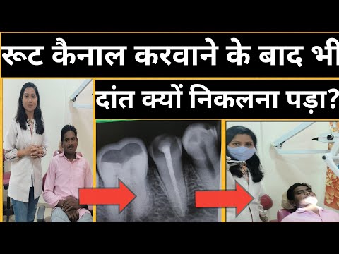 रूट कैनाल के बाद कप लगवाए या नहीं? |Root canal Karvaye Ya Nahi |Cost Of Root Canal Treatment