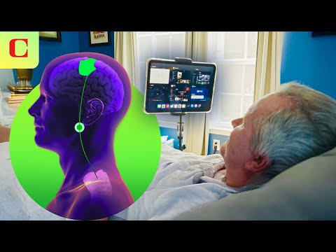 Synchron vs. Neuralink: BCI Brain Implants for Thought-Control