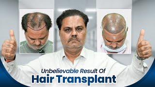 3,500 Grafts Hair Transplant in Ahmedabad | Amazing Results & Affordable Cost #hairtransplant