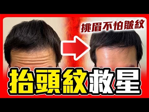 肉毒打完眼睛睜不開? 不自然? 鴿親身實測分享!