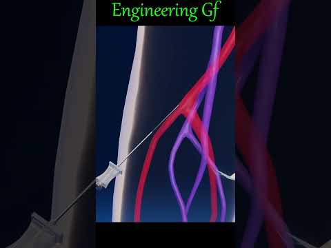 Coronary angioplasty #shorts